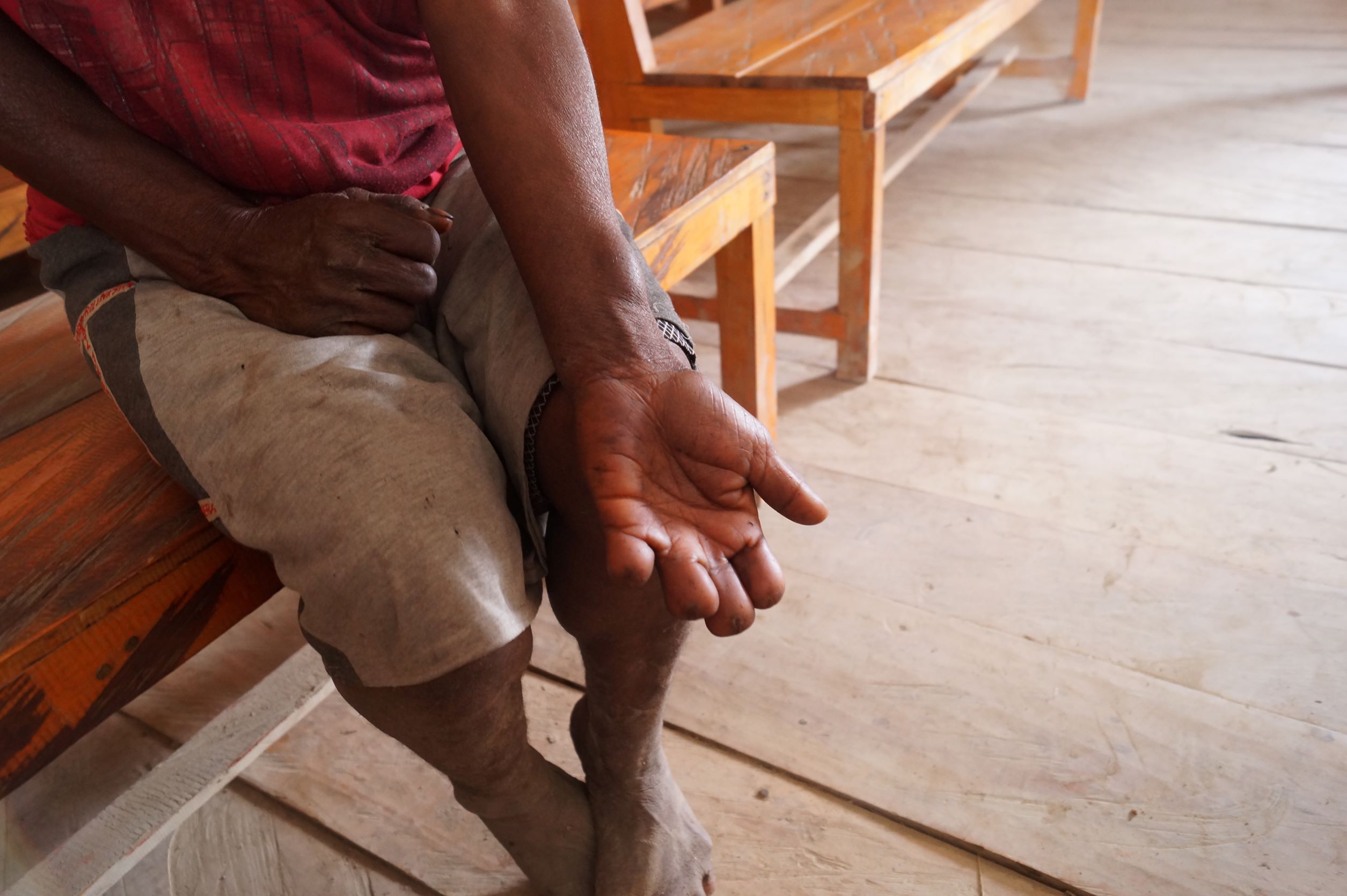 Tangan milik salah seorang mama di Distrik Wandai, Kabupaten Intan Jaya, Papua yang menjalankan Hane Zambaya karena beberapa anaknya yang meninggal dunia.